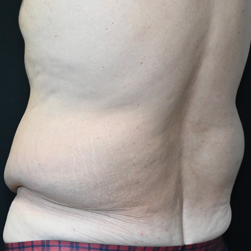 Body Lift Before & After Gallery - Patient 201497757 - Image 13