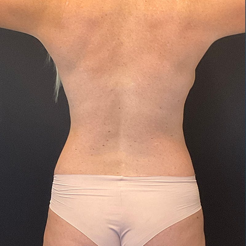 Breast Lift Before & After Gallery - Patient 201503510 - Image 11