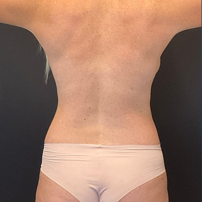 Breast Fat Grafting Before & After Gallery - Patient 201502221 - Image 11
