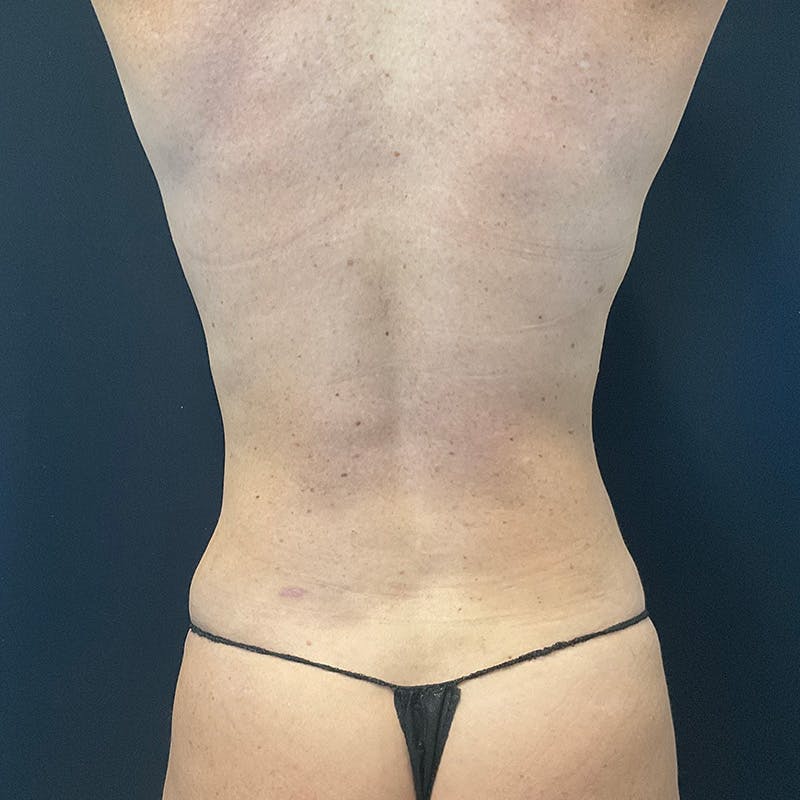 Abdominoplasty (Tummy Tuck) Before & After Gallery - Patient 201500974 - Image 12