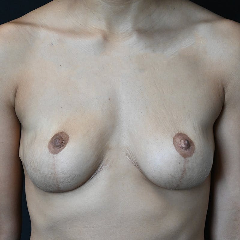 Breast Augmentation Before & After Gallery - Patient 201488803 - Image 1