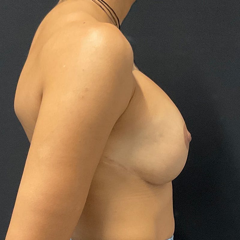 Breast Augmentation Before & After Gallery - Patient 201488803 - Image 6