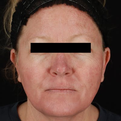 BroadBand Light™ Therapy Before & After Gallery - Patient 730274 - Image 1