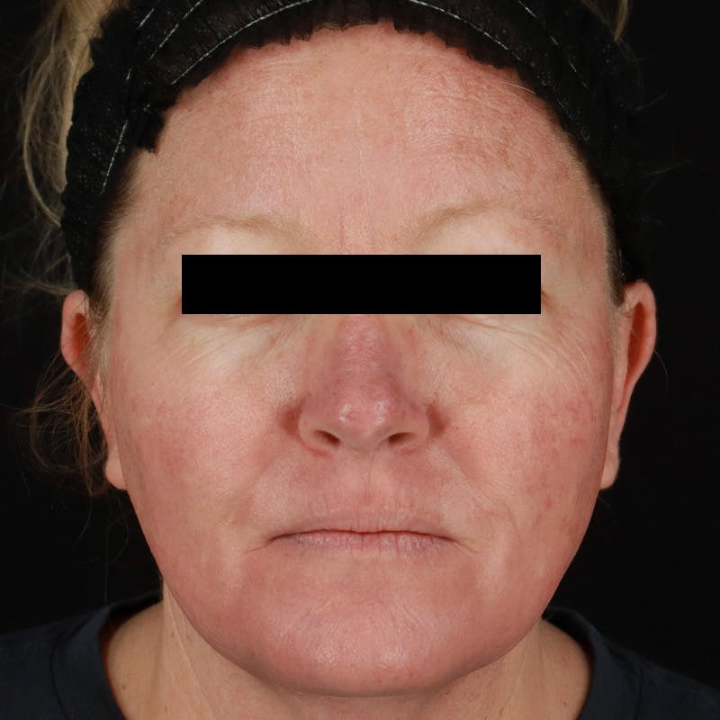 HALO™ Laser Treatment Before & After Gallery - Patient 201484858 - Image 1
