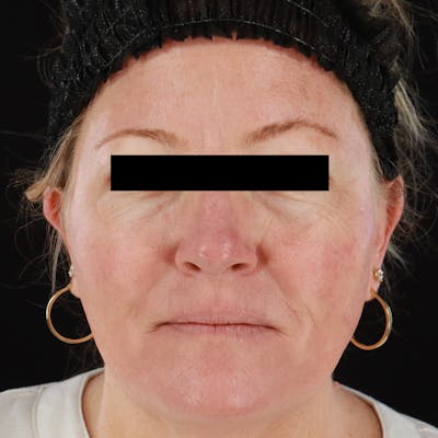 HALO™ Laser Treatment Before & After Gallery - Patient 201484858 - Image 2