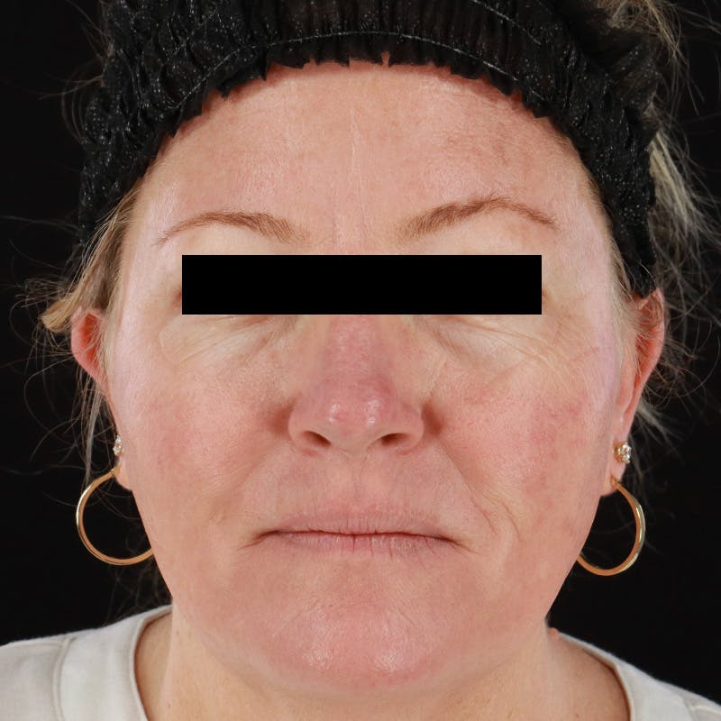 BroadBand Light™ Therapy Before & After Gallery - Patient 730274 - Image 2