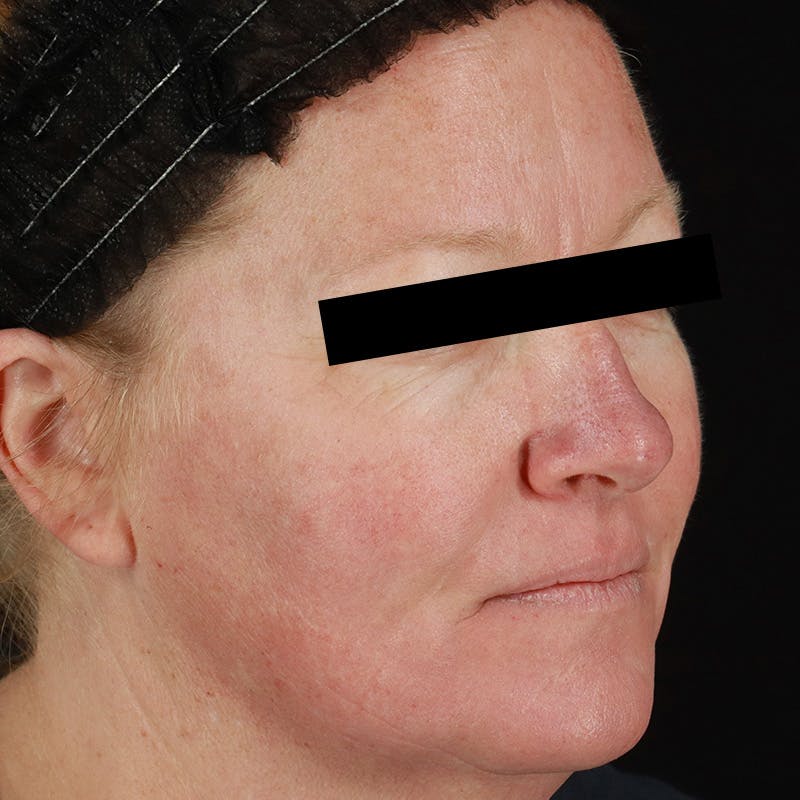 HALO™ Laser Treatment Before & After Gallery - Patient 201484858 - Image 3