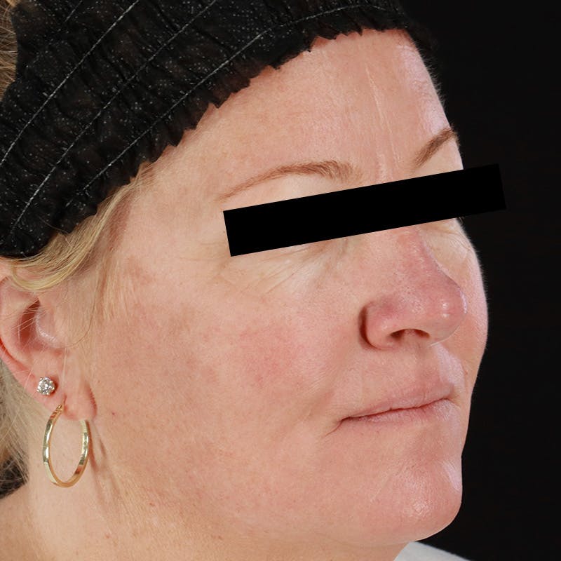 HALO™ Laser Treatment Before & After Gallery - Patient 201484858 - Image 4