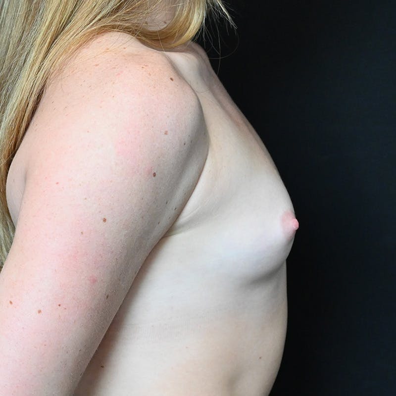 Breast Augmentation Before & After Gallery - Patient 201488817 - Image 5