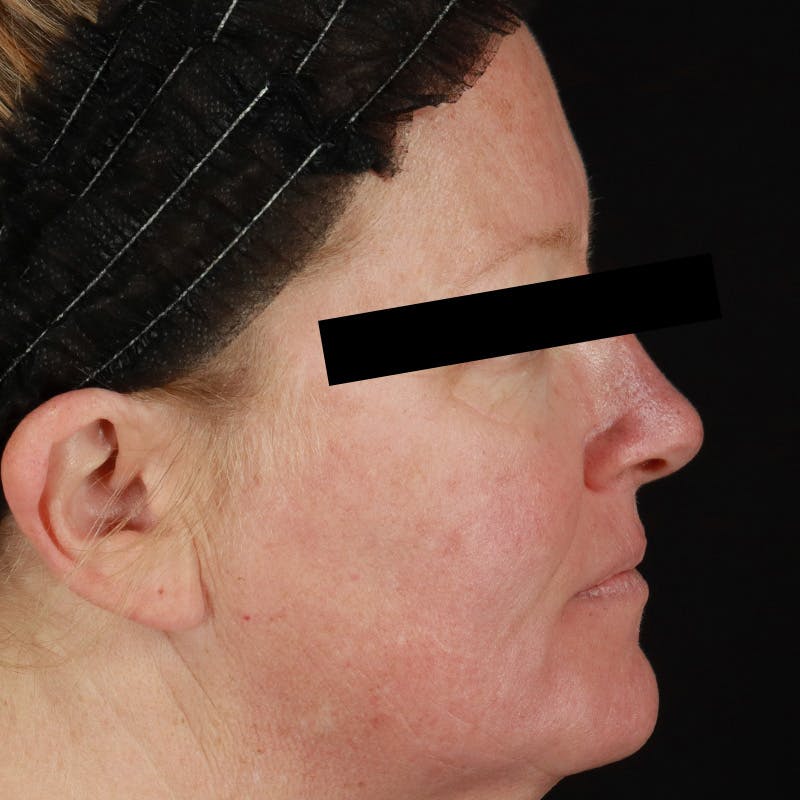 HALO™ Laser Treatment Before & After Gallery - Patient 201484858 - Image 5