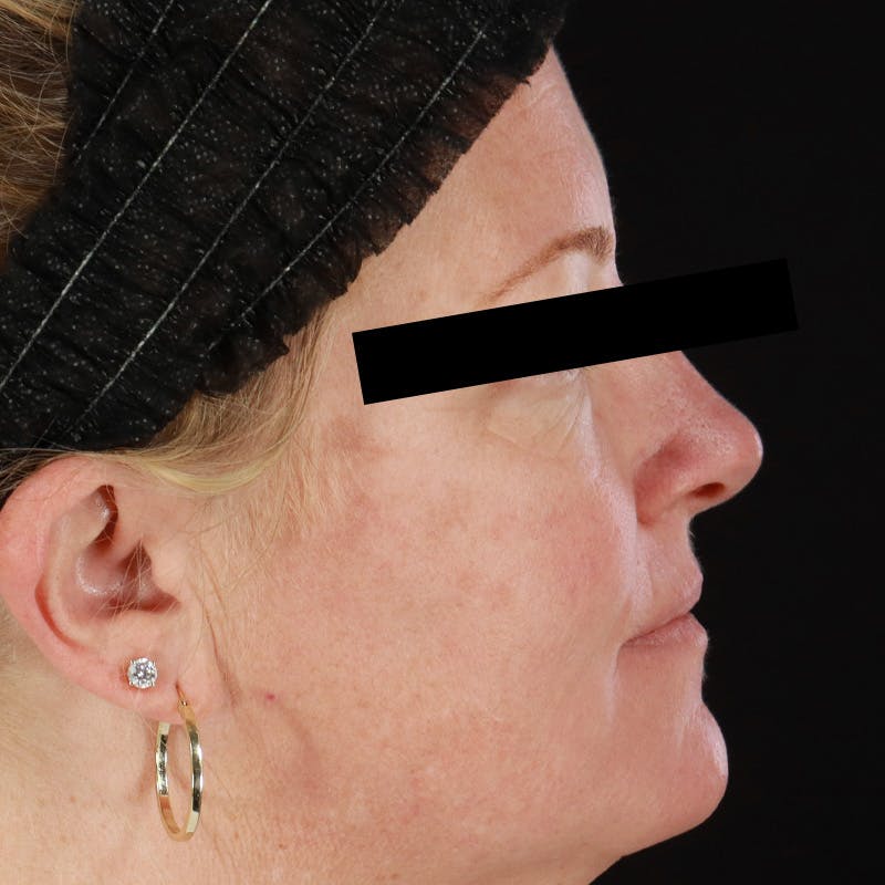 HALO™ Laser Treatment Before & After Gallery - Patient 201484858 - Image 6