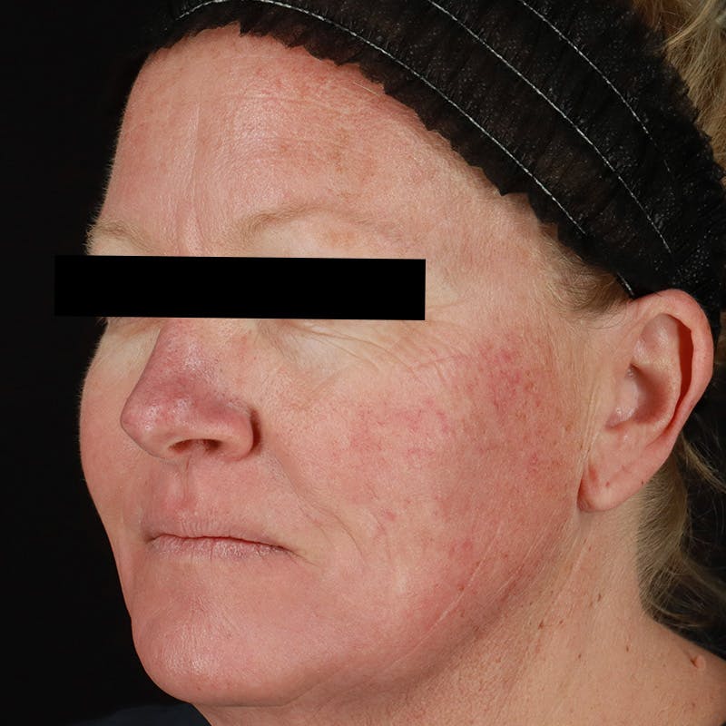 HALO™ Laser Treatment Before & After Gallery - Patient 201484858 - Image 7