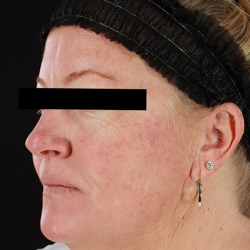 HALO™ Laser Treatment Before & After Gallery - Patient 201484858 - Image 8