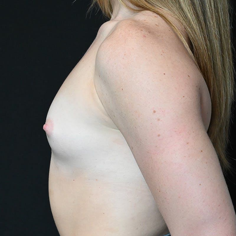 Breast Augmentation Before & After Gallery - Patient 201488817 - Image 9