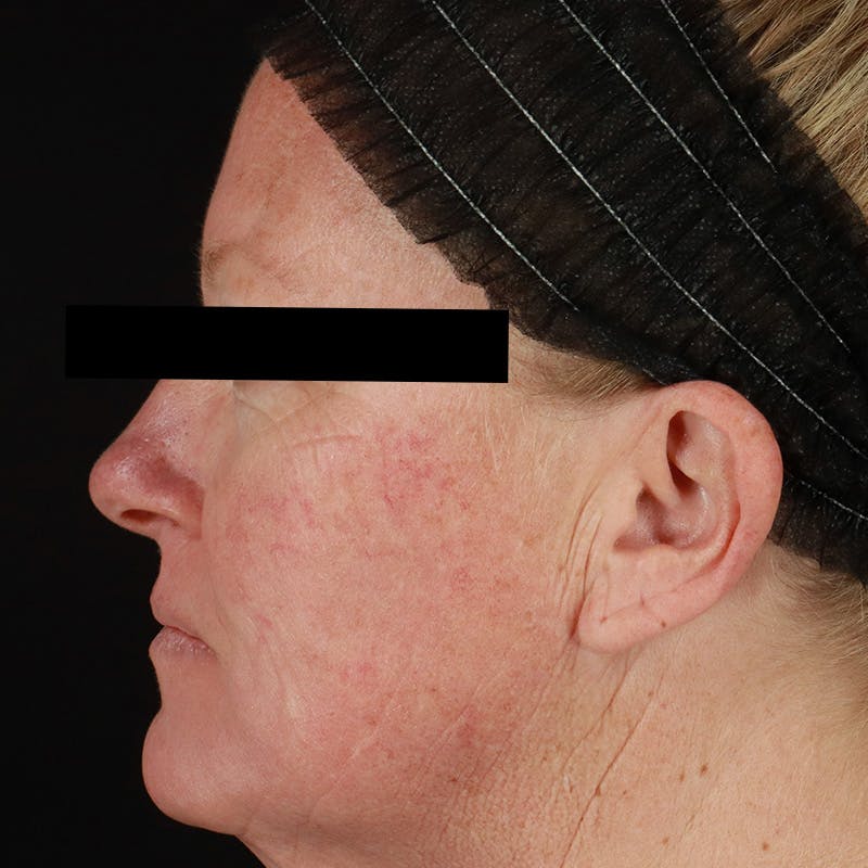 HALO™ Laser Treatment Before & After Gallery - Patient 201484858 - Image 9