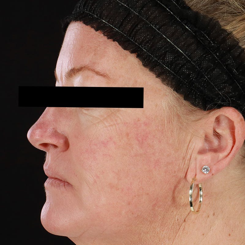 HALO™ Laser Treatment Before & After Gallery - Patient 201484858 - Image 10