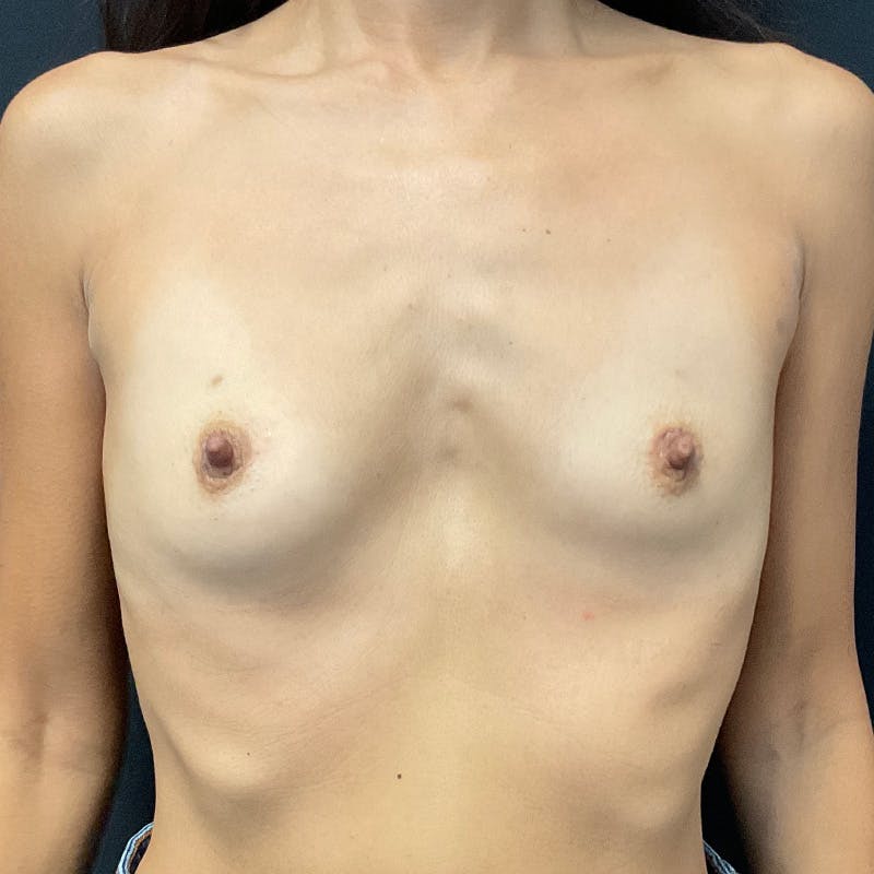 Breast Augmentation Before & After Gallery - Patient 201489977 - Image 1