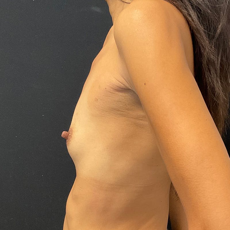 Breast Augmentation Before & After Gallery - Patient 201489977 - Image 9