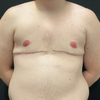 Transgender Top Surgery Before & After Gallery - Patient 201508813 - Image 2