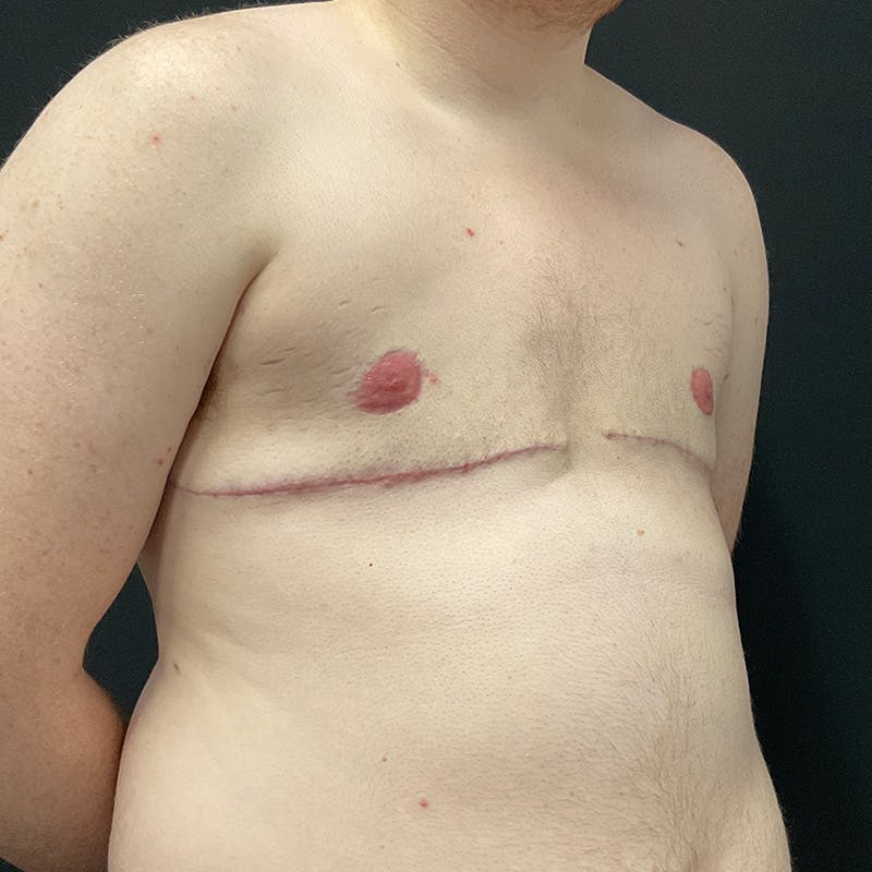 Transgender Top Surgery Before & After Gallery - Patient 201508813 - Image 4