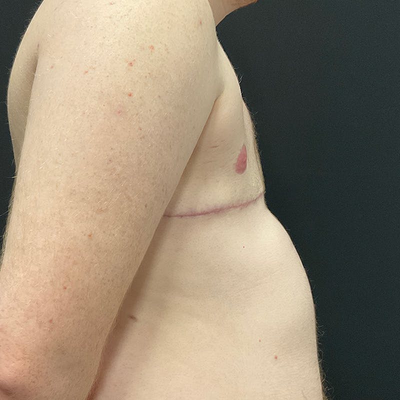 Transgender Top Surgery Before & After Gallery - Patient 201508813 - Image 6