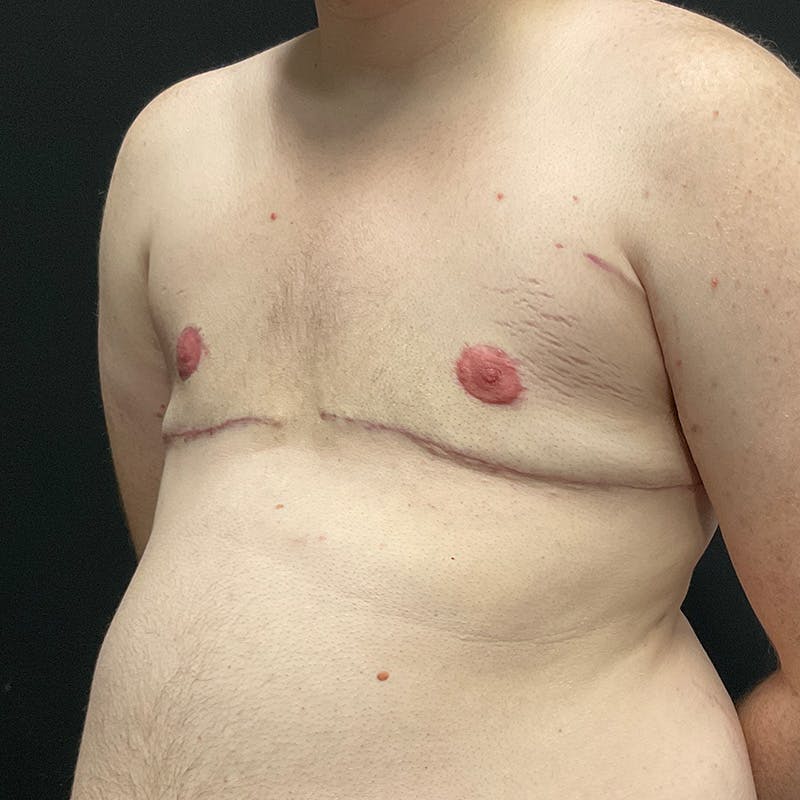 Transgender Top Surgery Before & After Gallery - Patient 201508813 - Image 8