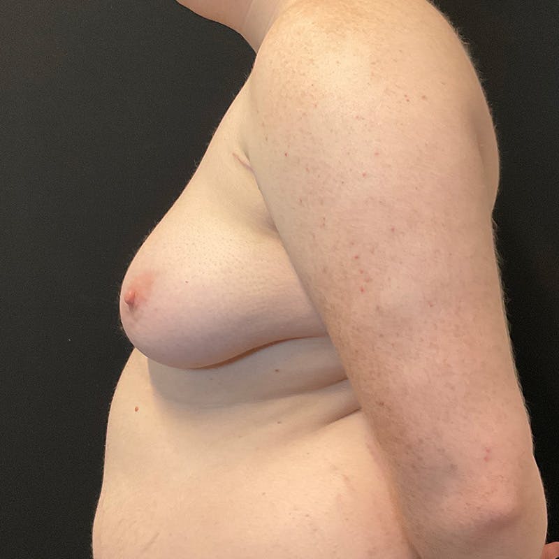 Transgender Top Surgery Before & After Gallery - Patient 201508813 - Image 9