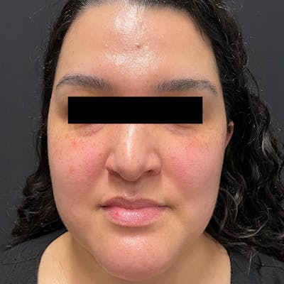 BroadBand Light™ Therapy Before & After Gallery - Patient 145274 - Image 1