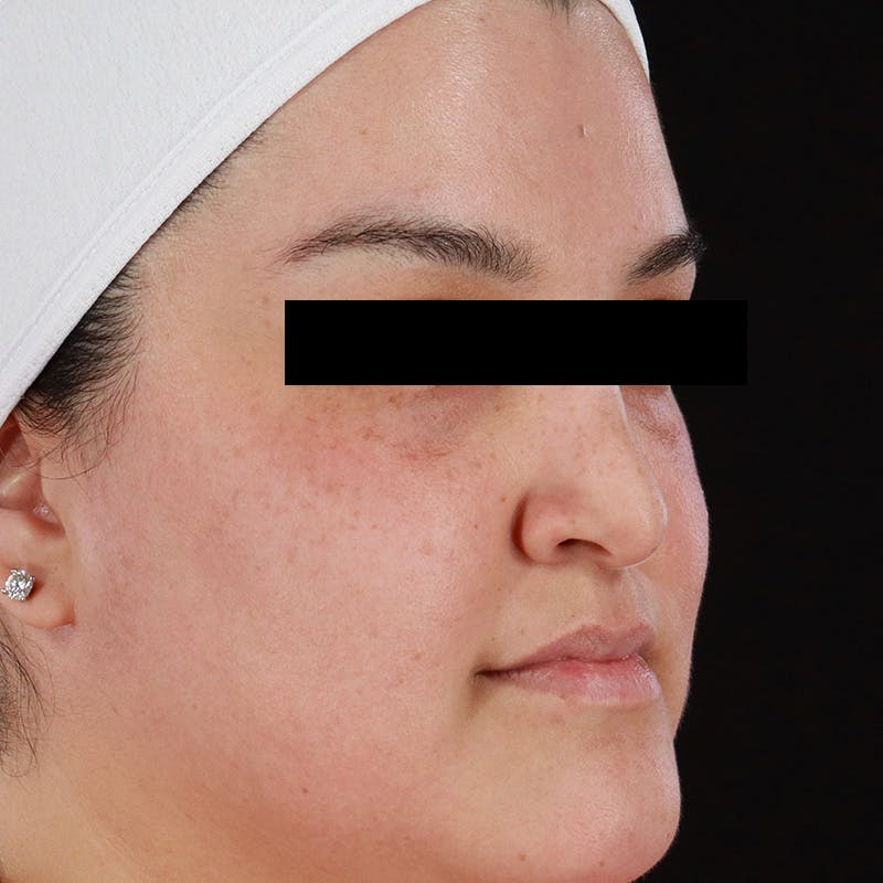 BroadBand Light™ Therapy Before & After Gallery - Patient 145274 - Image 4