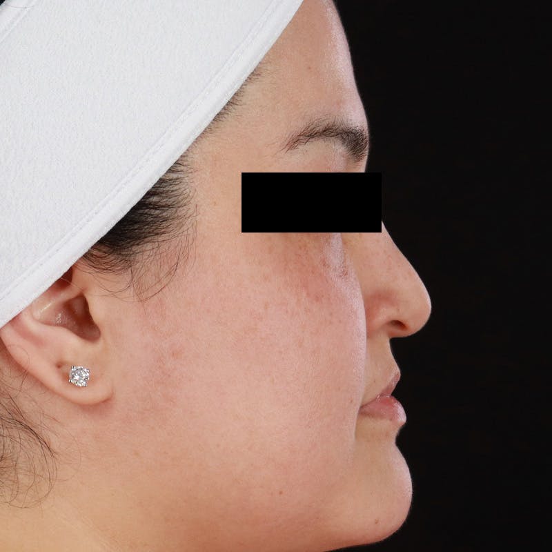 BroadBand Light™ Therapy Before & After Gallery - Patient 145274 - Image 6