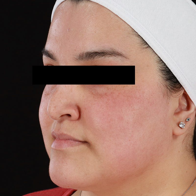 BroadBand Light™ Therapy Before & After Gallery - Patient 145274 - Image 8