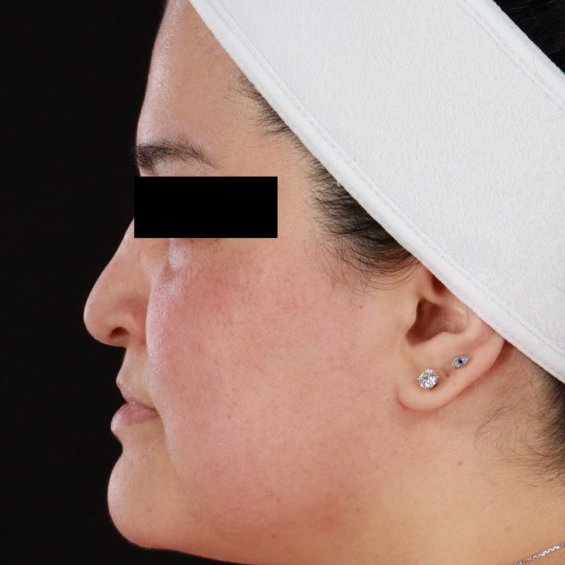 BroadBand Light™ Therapy Before & After Gallery - Patient 145274 - Image 10