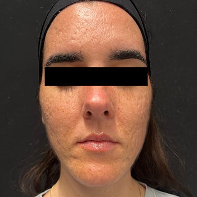 HALO™ Laser Treatment Before & After Gallery - Patient 201484978 - Image 1