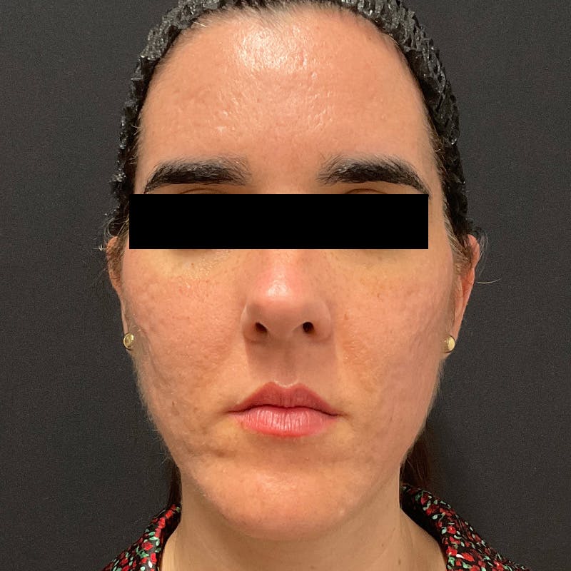 HALO™ Laser Treatment Before & After Gallery - Patient 201484978 - Image 2