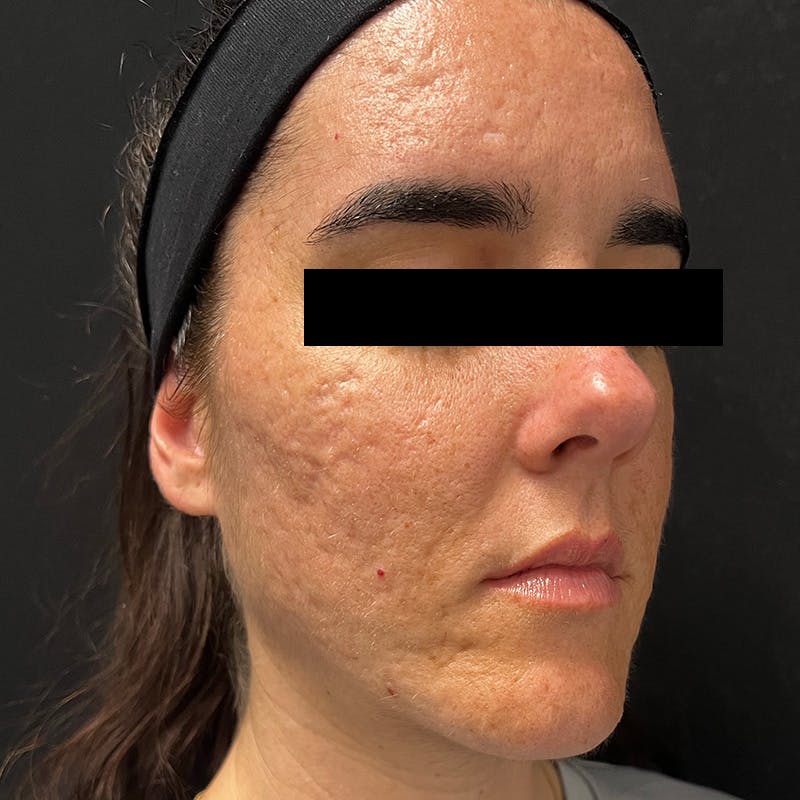 HALO™ Laser Treatment Before & After Gallery - Patient 201484978 - Image 3