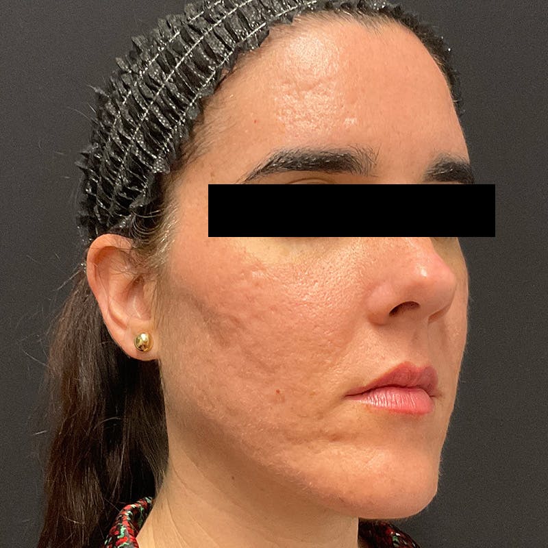 HALO™ Laser Treatment Before & After Gallery - Patient 201484978 - Image 4