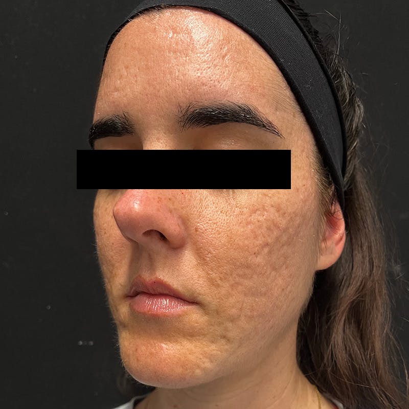 HALO™ Laser Treatment Before & After Gallery - Patient 201484978 - Image 5