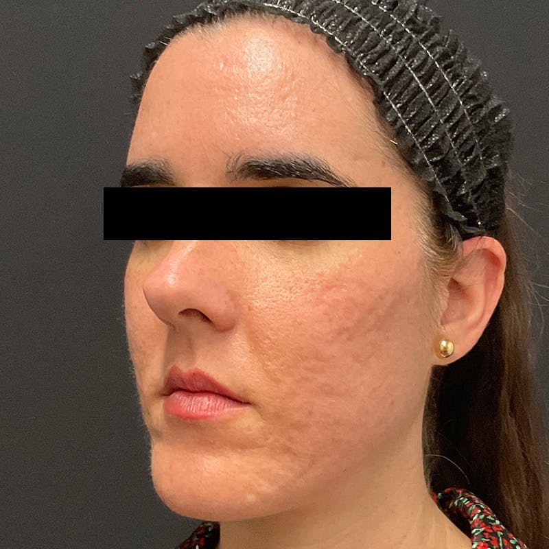HALO™ Laser Treatment Before & After Gallery - Patient 201484978 - Image 6