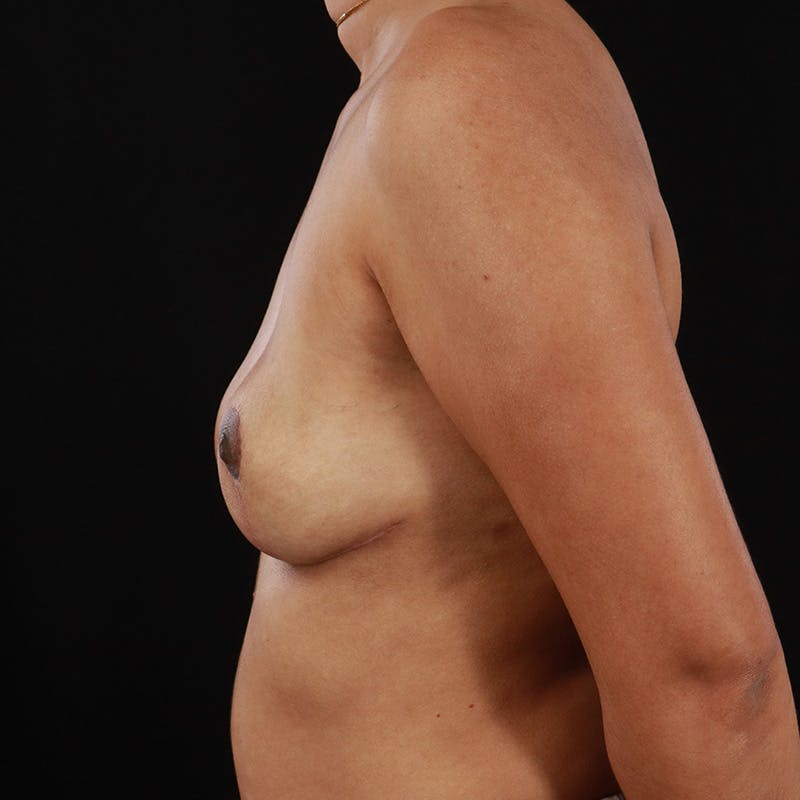 Breast Explant with Lift Before & After Gallery - Patient 330912 - Image 10