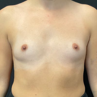 Breast Augmentation Before & After Gallery - Patient 240684 - Image 1