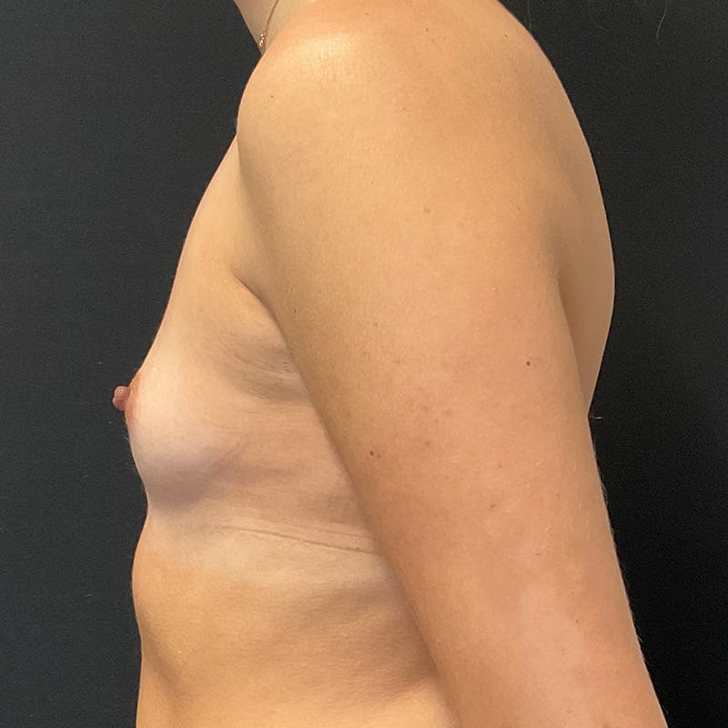 Breast Augmentation Before & After Gallery - Patient 240684 - Image 9