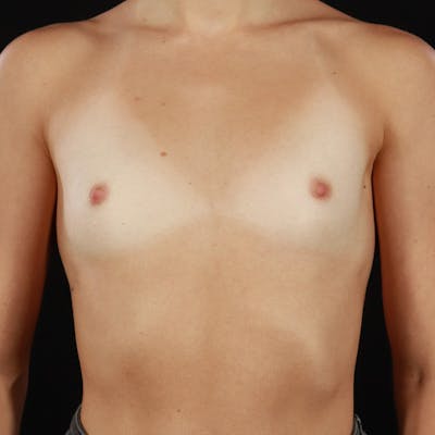 Breast Augmentation Before & After Gallery - Patient 158716 - Image 1