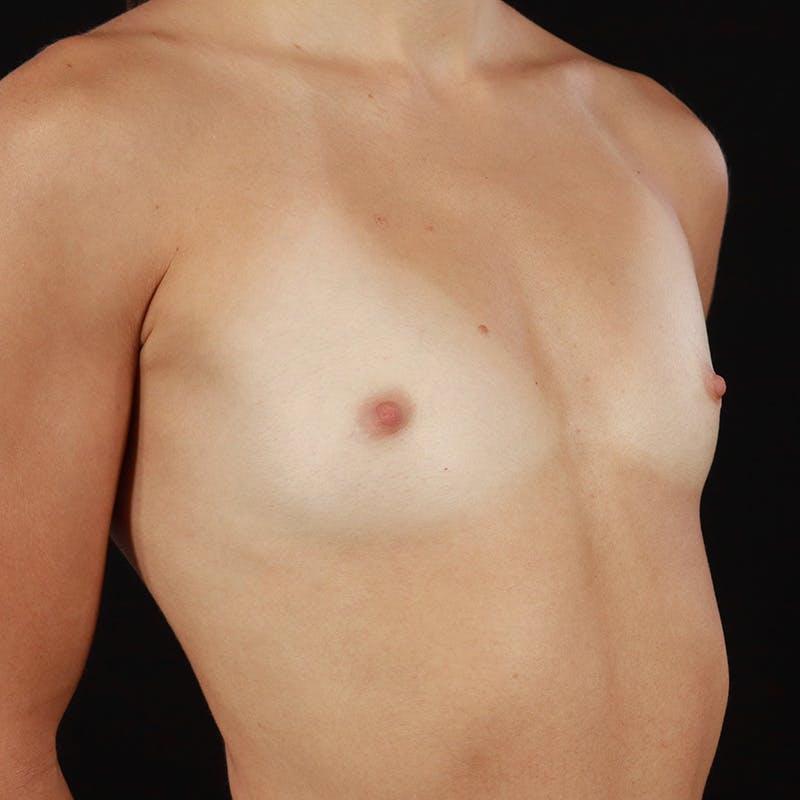 Breast Augmentation Before & After Gallery - Patient 158716 - Image 3