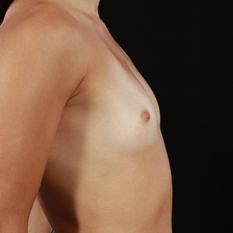 Breast Augmentation Before & After Gallery - Patient 158716 - Image 5