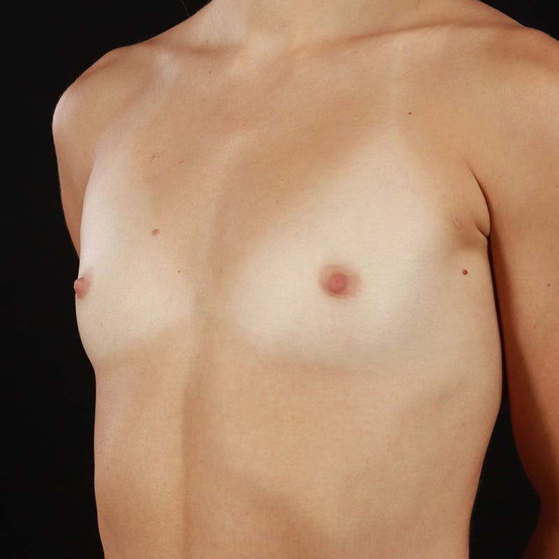 Breast Augmentation Before & After Gallery - Patient 158716 - Image 7