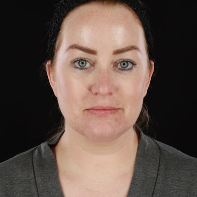 Morpheus8 Before & After Gallery - Patient 259087 - Image 2