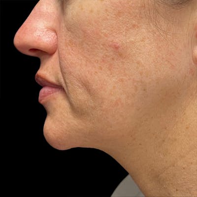 HALO™ Laser Treatment Before & After Gallery - Patient 324688 - Image 1