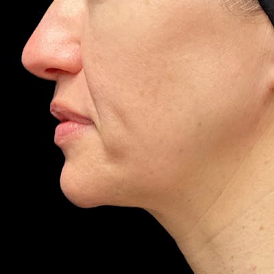 HALO™ Laser Treatment Before & After Gallery - Patient 324688 - Image 2