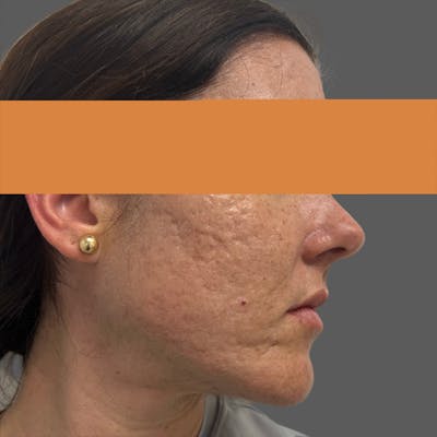 HALO™ Laser Treatment Before & After Gallery - Patient 235074 - Image 1