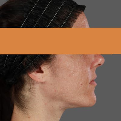 HALO™ Laser Treatment Before & After Gallery - Patient 235074 - Image 2